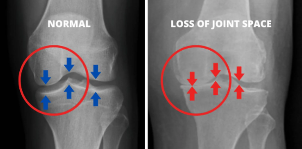 Active Move Joint Health UK Reviews - Explained Complete Guide: How It Works, Pros, Cons & Results