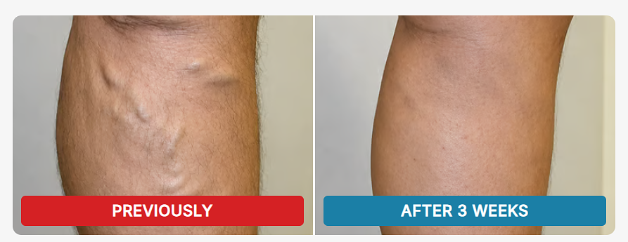 Why Everyone Is Talking About Venorela Varicose Veins Cream UK Why Everyone Is Talking About Venorela Varicose Veins Cream UK